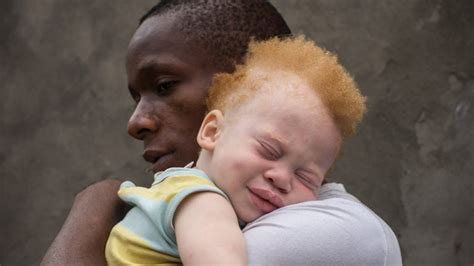 albino feio|About albinism. Beyond Race, Ethnicity and Gender